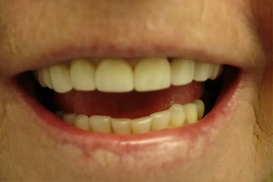 Smile after treatment
