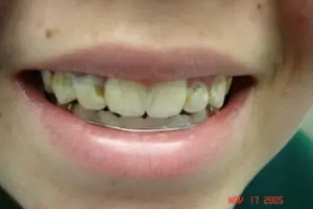 Smile before treatment