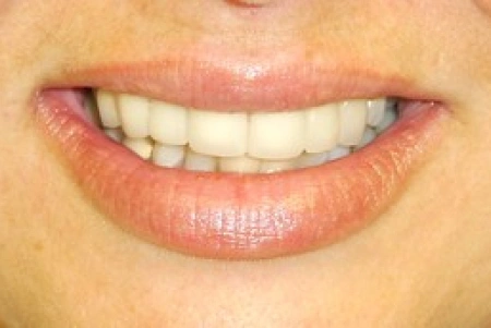 After Teeth Whitening Treatment In Glendora