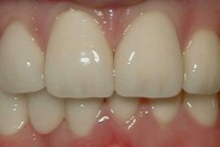 After Teeth Whitening Treatment At Glendora Healthy Smiles