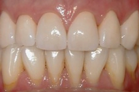 After Teeth Whitening At Glendora Healthy Smiles