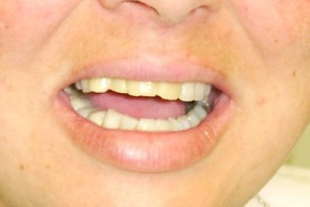 Before Teeth Whitening in Glendora