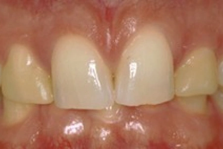 Before Teeth Whitening Treatment At Glendora Healthy Smiles