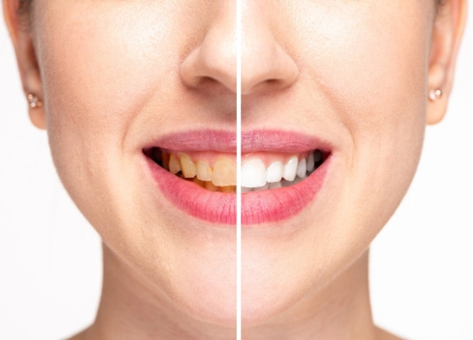 Can Teeth Whitening Fix Stained Teeth