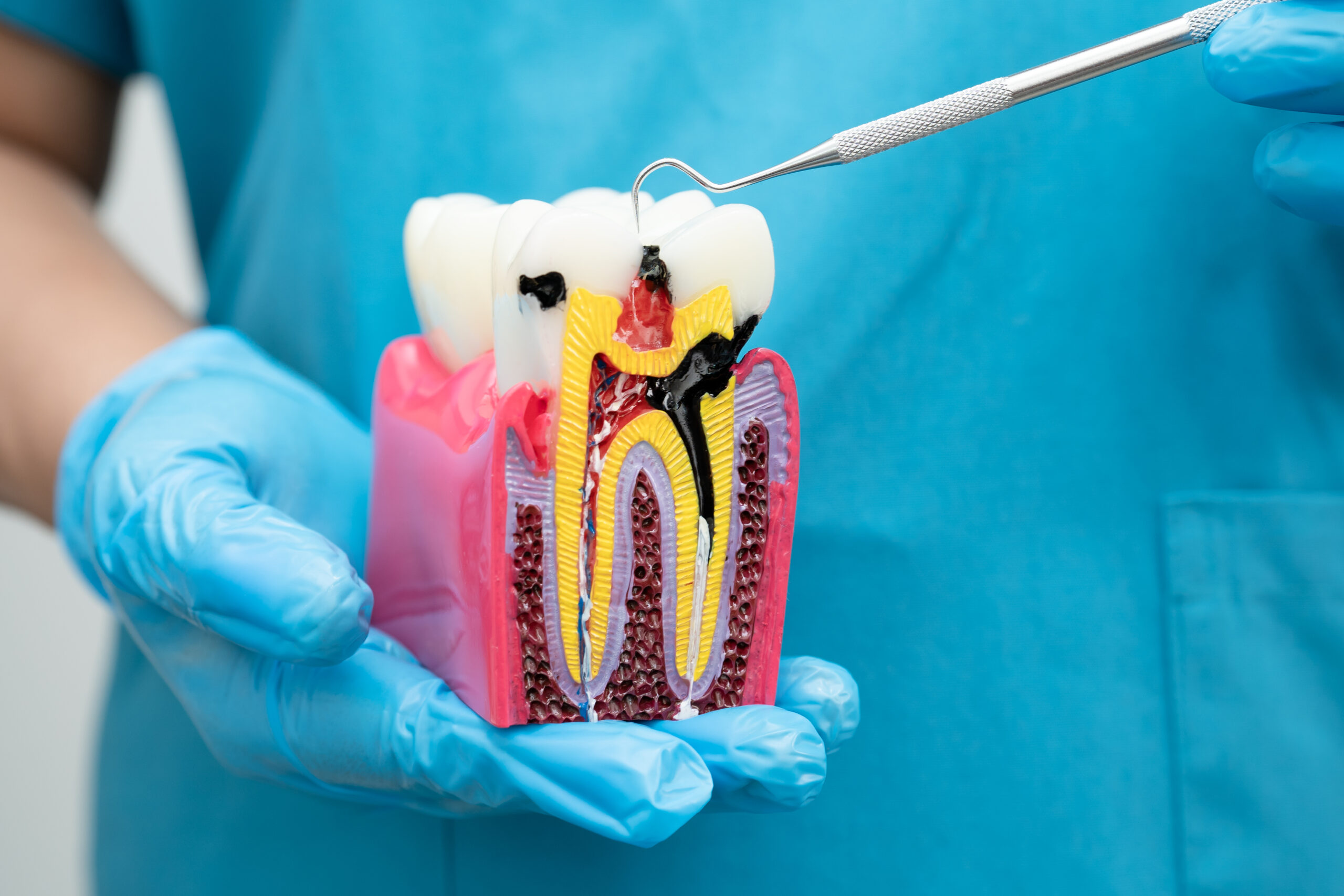 how root canal therapy saves your natural tooth