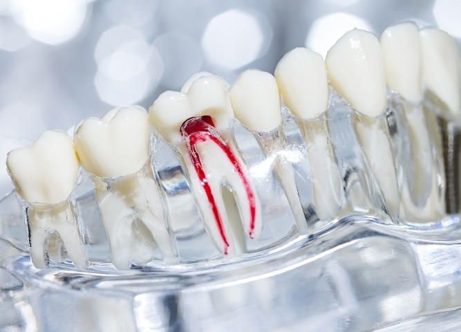 how to know if you need a root canal