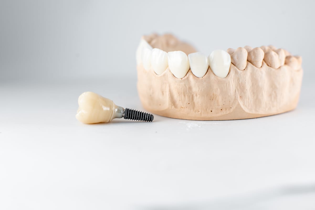 Dental Implants in Azusa