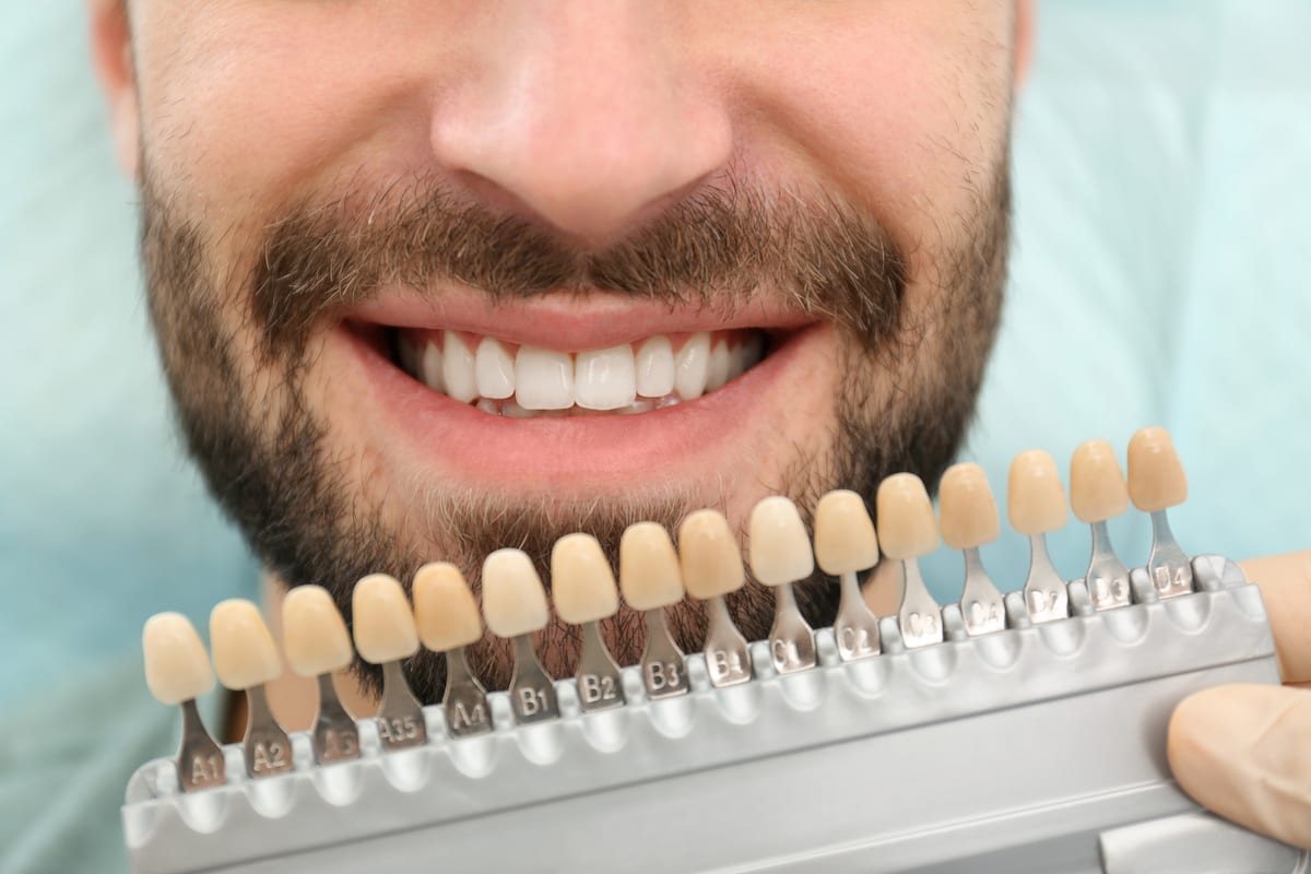 Veneers in Glendora